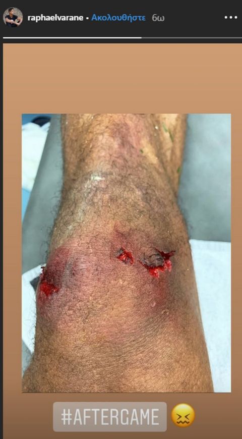 Ο Βαράν "τρόμαξε" το Instagram με το τραυματισμένο του γόνατο