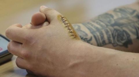 Η ανατριχιαστική φωτογραφία με το τραυματισμένο χέρι του Ράκιτιτς