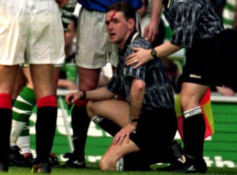 HUGH DALLAS COIN
Blood pours from a cut on referee Hugh Dallas' head after he was struck by a coin thrown from the crowd