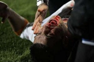 Κάταγμα στη μύτη ο Κίβου