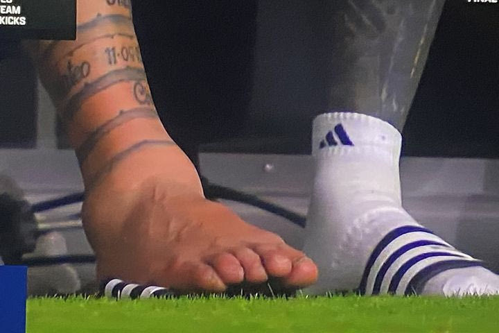 Μέσι: Η σοκαριστική εικόνα του πρησμένου αστράγαλου του Αργεντίνου