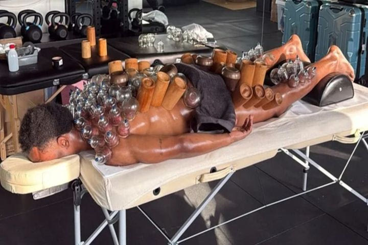 Γιουβέντους: Ο Οπέντα έγινε viral μετά τη θεραπεία με βεντούζες που κάλυψαν όλο του το σώμα